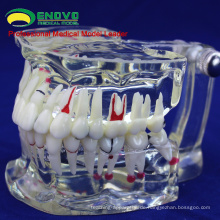 VERKAUFEN Sie 12568 Adult Dental Zähne Transparent Disse Modell zeigen Karies